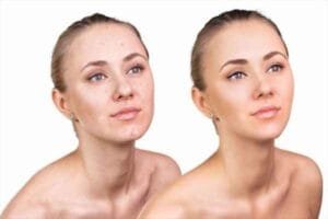 Should I Use Makeup Primer If I Have Acne