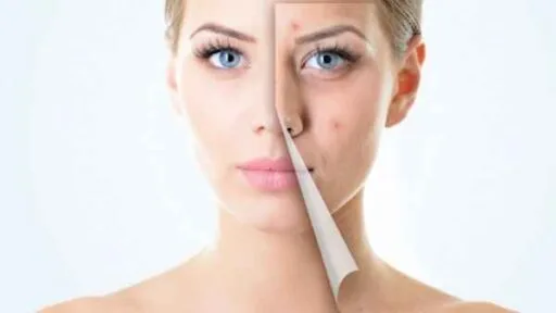 Should I Use Makeup Primer If I Have Acne Prone Skin