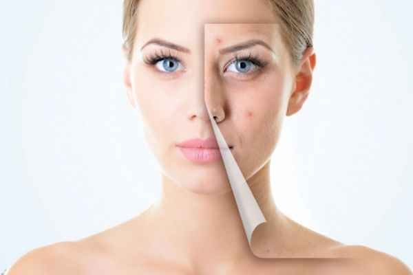 Should I Use Makeup Primer If I Have Acne Prone Skin